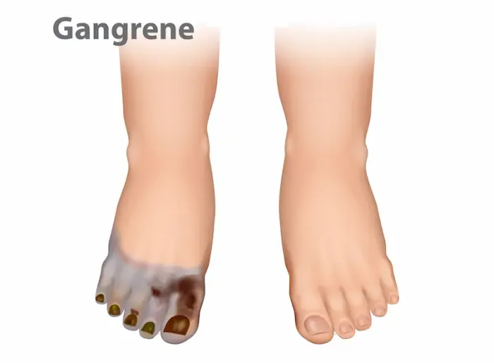 Understanding Gangrene and Its Treatment Options